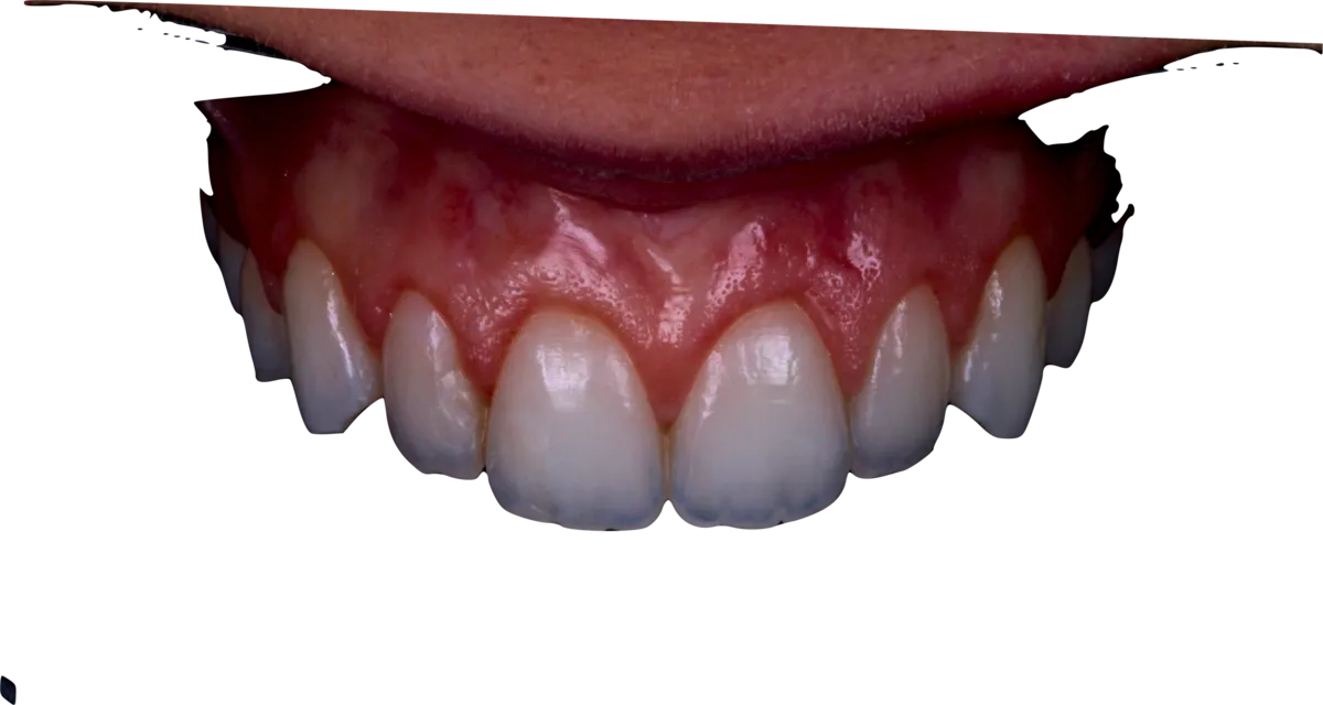 Sorriso com gengiva saudável após tratamento periodontal